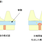 胸腰部椎間板ヘルニア　～急に足が立たなくなった～